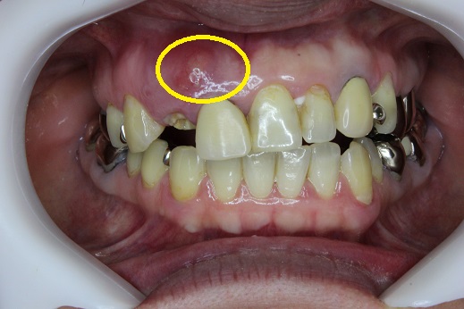 割れた歯の周囲に溜まった膿