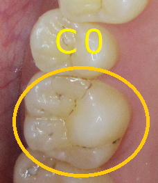 初期虫歯（C0）