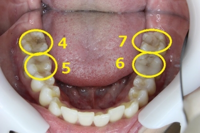 下の歯の初期虫歯