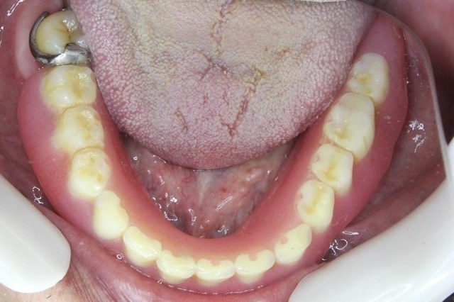 下顎の義歯