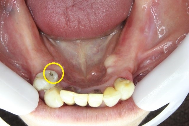 下の歯の問題点
