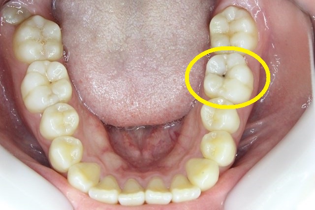 奥歯の小さい虫歯