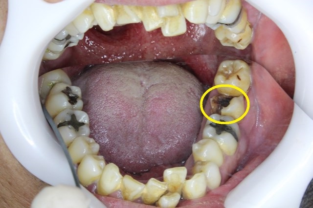 下顎の虫歯
