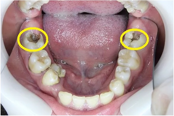 左右奥歯の虫歯