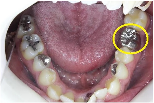 奥歯の銀歯