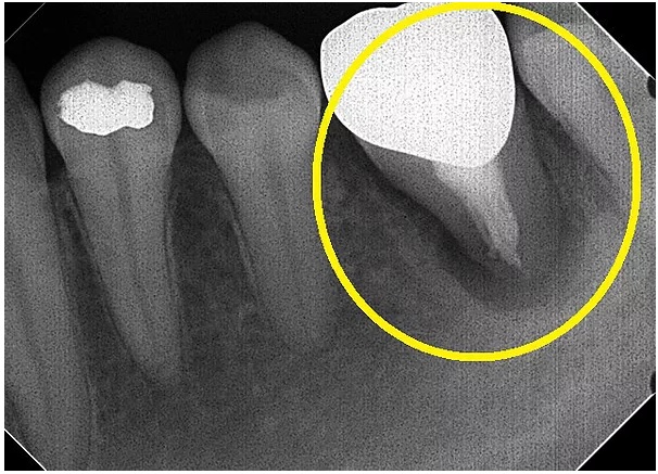 膿がたまった歯根のレントゲン写真
