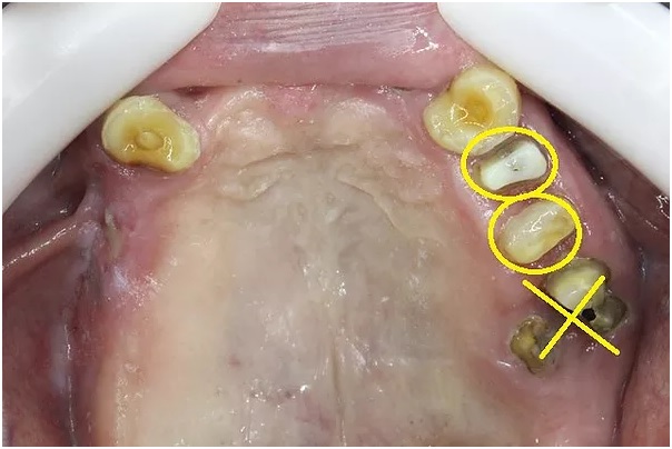 残せる歯と抜歯の歯