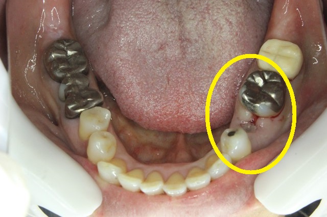 残根の歯