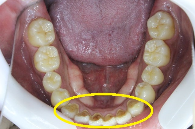 下顎の歯石