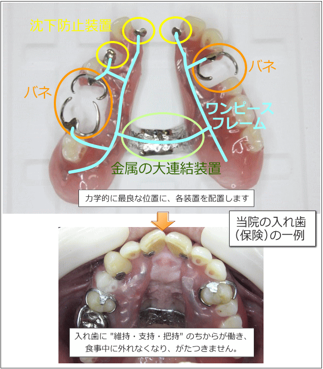 入れ歯の構造図