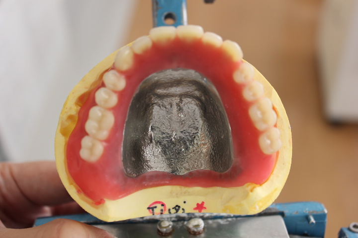 試適前の金属床義歯