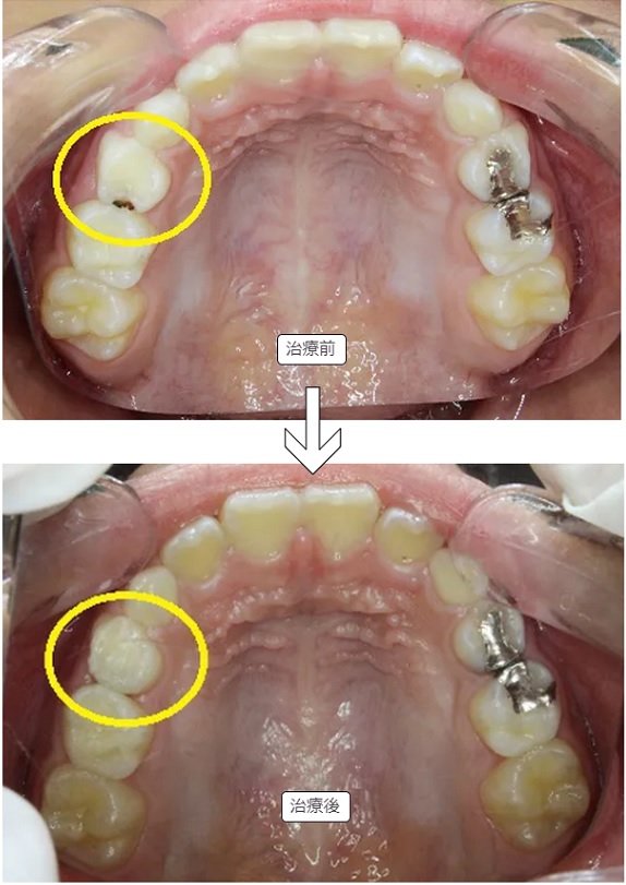 乳歯の虫歯 治療前・治療後