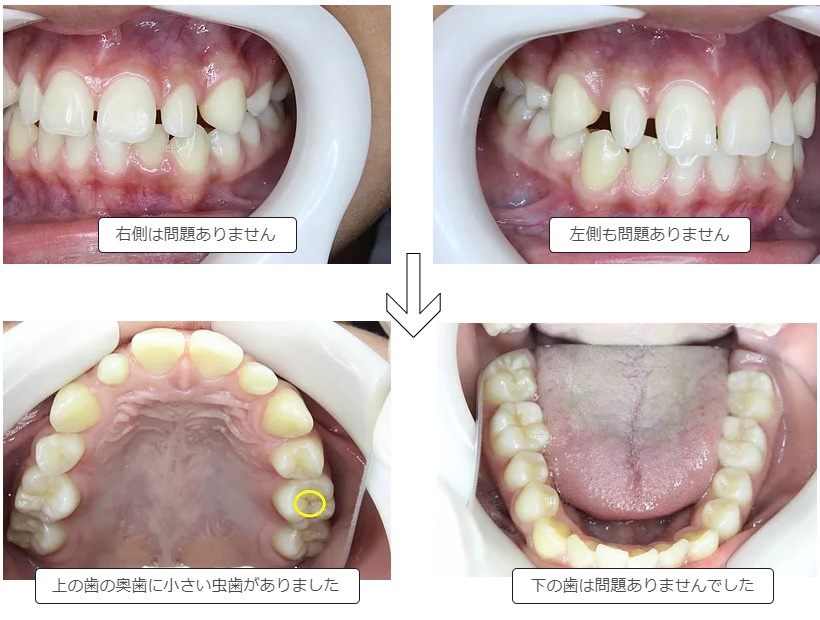定期健診で見つかった虫歯
