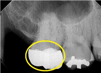 奥歯のレントゲン