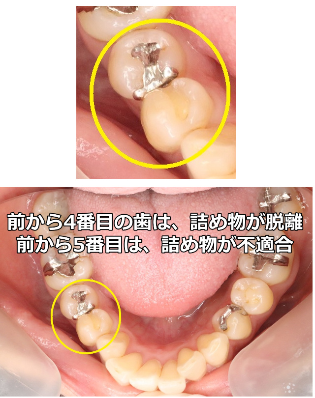 前から4番目の歯は脱離、5番目の歯は不適合