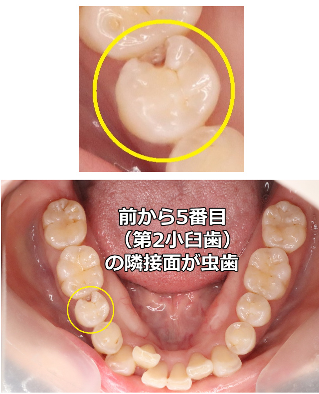 前から5番目の歯の隣接面が虫歯