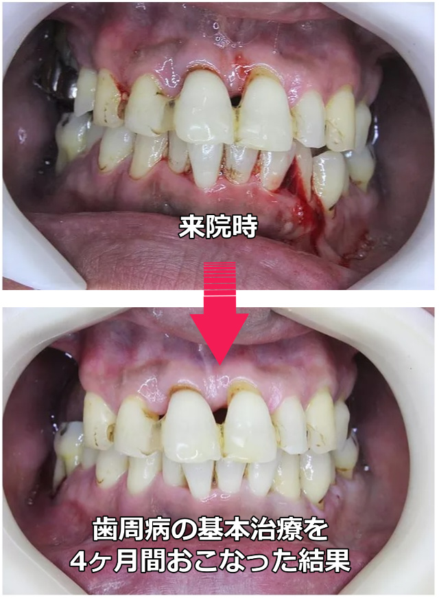 歯周基本治療後