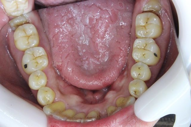 歯周基本治療後の下顎
