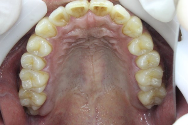 上顎の歯石