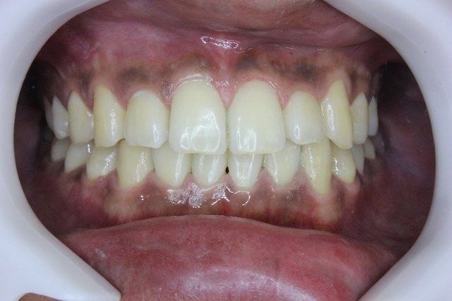 歯石除去・クリーニング後の、綺麗になった歯