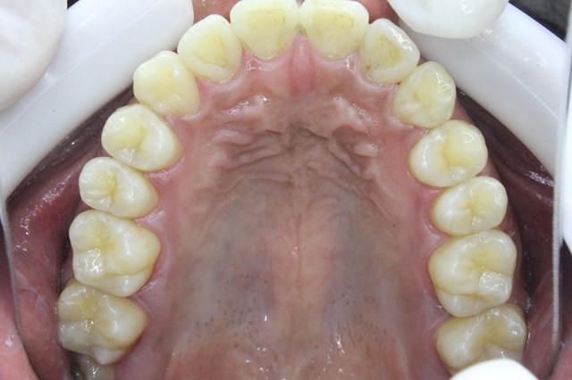 歯石除去・クリーニング後の上顎