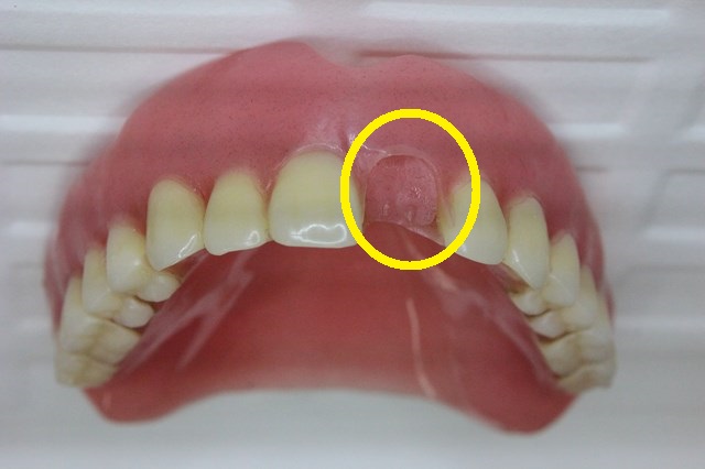 人工歯が脱離した熱可塑性義歯