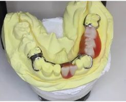 模型上のロー義歯