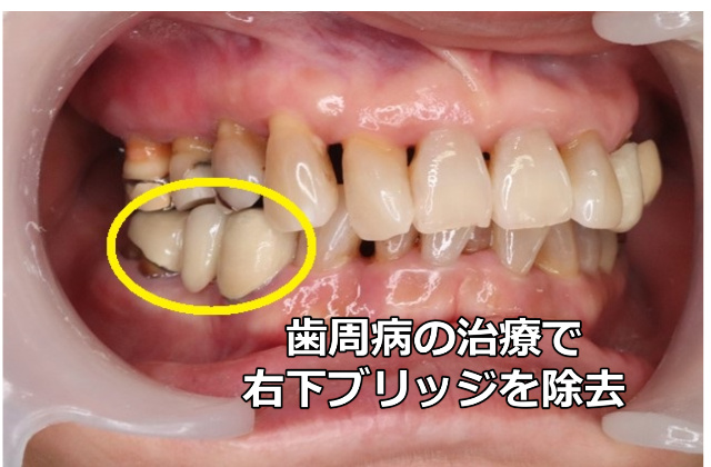 右下奥歯の写真