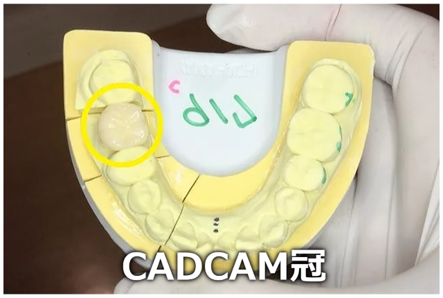 手で持ったCADCAM冠
