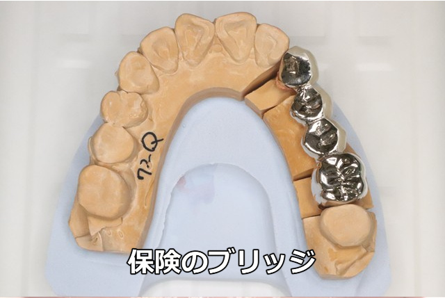 保険のブリッジの写真