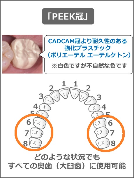 PEEK冠の適用範囲
