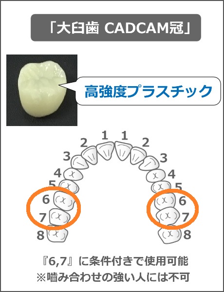 大臼歯CADCAM冠の適用範囲