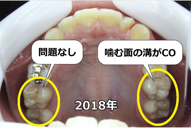 上顎左右奥歯のCO（2018年）