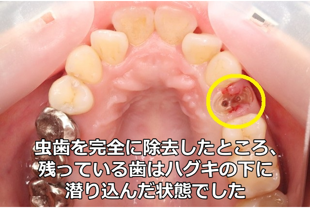 残根の虫歯を完全に除去したあと