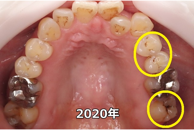 上顎臼歯部のC0、C1（2020年）