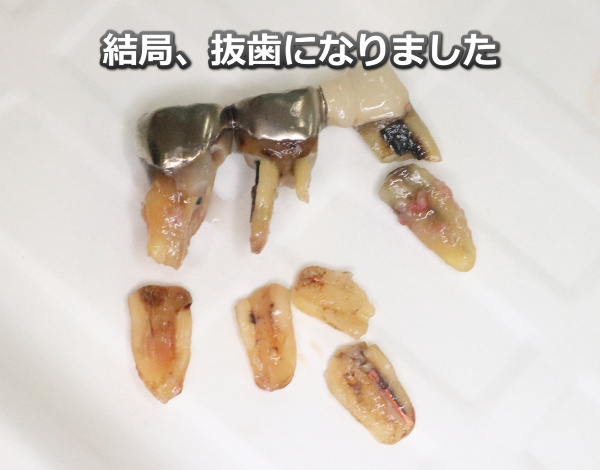 歯を抜いた写真