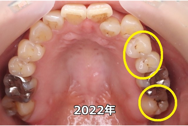 上顎臼歯部のC0、C1（2022年）