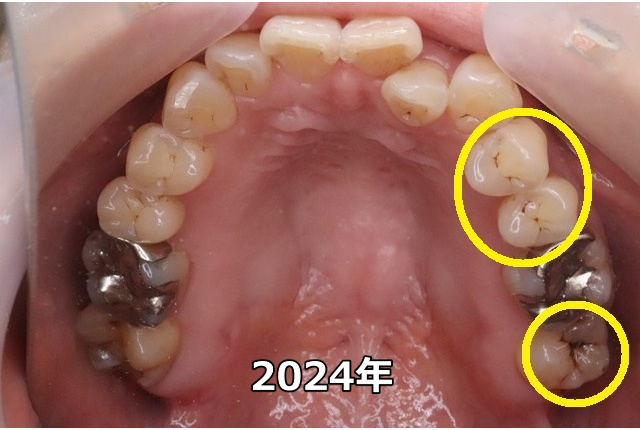 上顎臼歯部のC0、C1（2024年）
