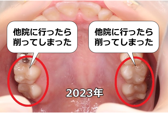 上顎左右奥歯を他院で削った後（2023年）