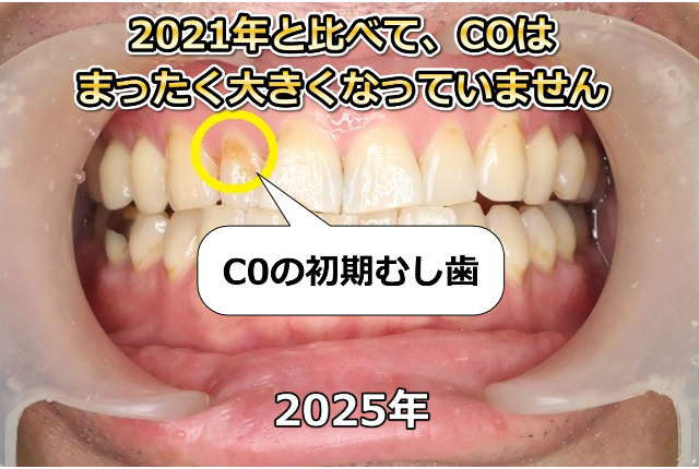 上顎前歯部のCO（2025年）