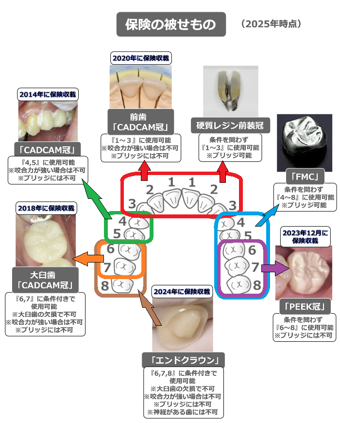 2025年　保険の被せ物の種類
