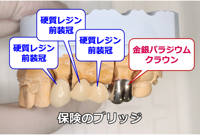 横から見た保険のブリッジ