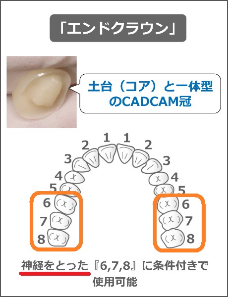 エンドクラウンの適用範囲