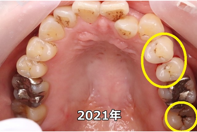 上顎臼歯部のC0、C1（2021年）