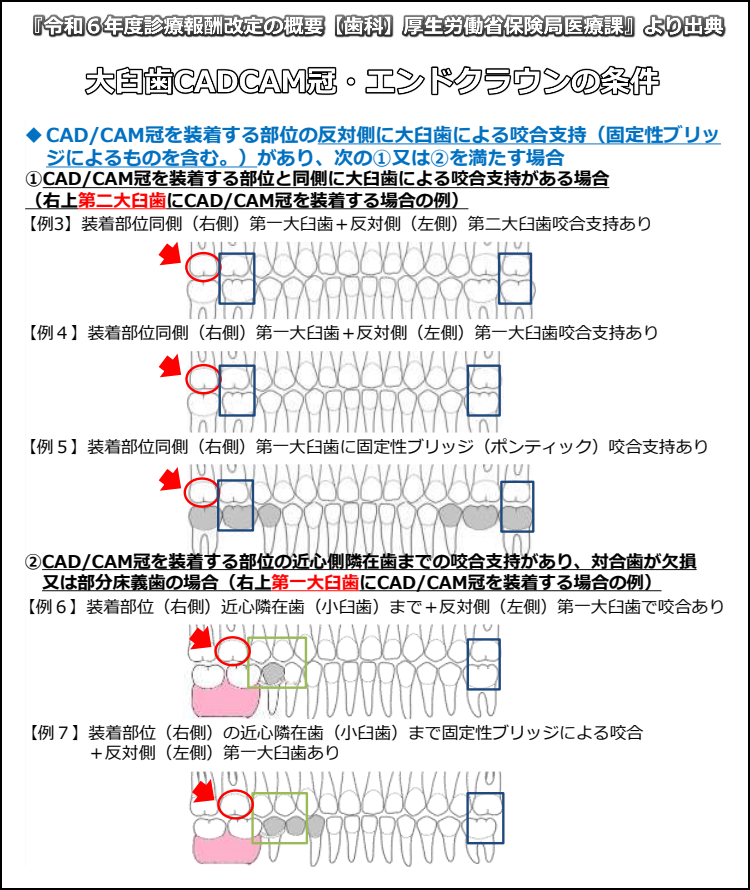 大臼歯CADCAM冠・エンドクラウンの条件図
