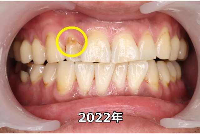 上顎前歯部のCO（2022年）