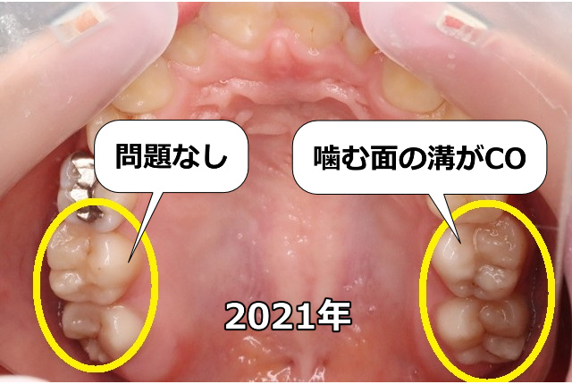 上顎左右奥歯のCO（2021年）