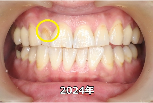 上顎前歯部のCO（2024年）