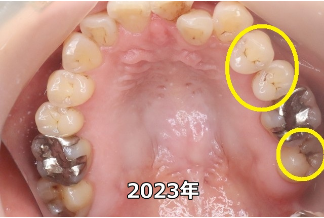 上顎臼歯部のC0、C1（2023年）