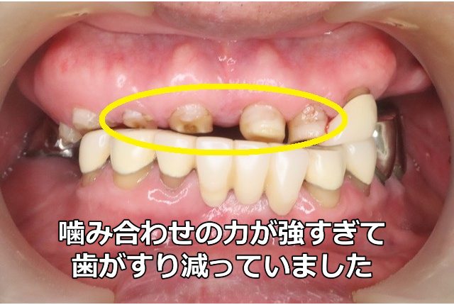 擦り減った上顎前歯